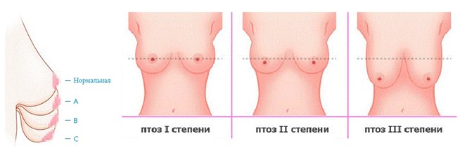 Птоз груди после лактации и кормления