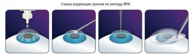 Перечень ограничений после лазерной коррекции зрения