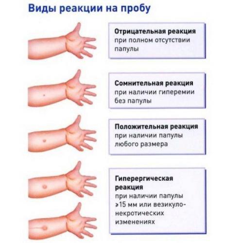 Нормы и отклонения при выполнении реакции манту взрослому человеку