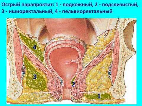 Подкожный парапроктит: причины, симптомы, лечение