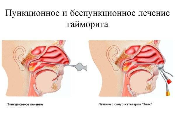 Гайморит при беременности, как лечить фронтит, синусит на ранних сроках и последствия для ребенка