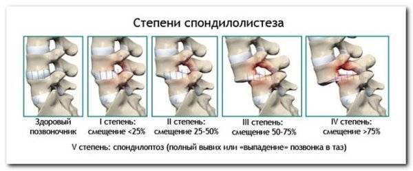 Растяжка позвоночника при грыже поясничного отдела в домашних условиях