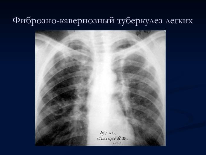 Развитие фиброзно-кавернозной формы туберкулеза