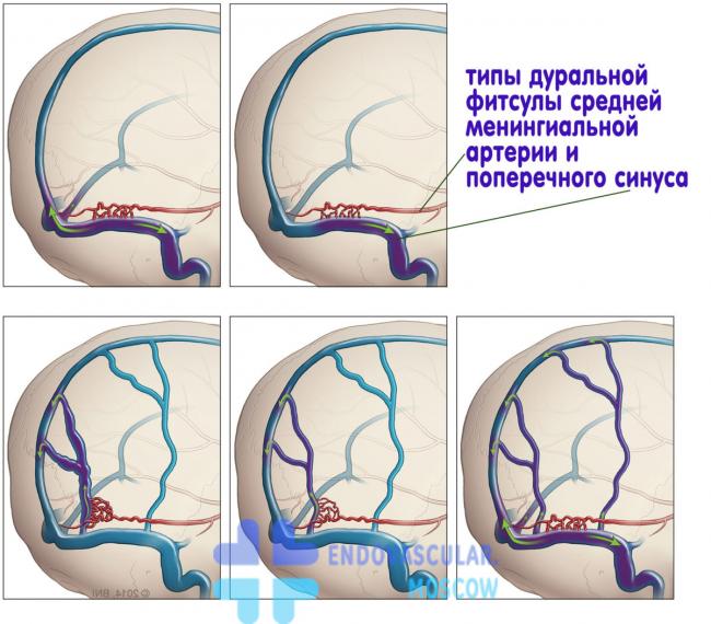 Артериовенозная фистула – симптомы, лечение, формы, стадии, диагностика