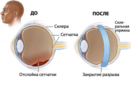 Макулярный разрыв сетчатки