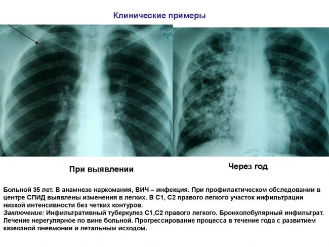 Может ли пневмония перейти в туберкулёз?