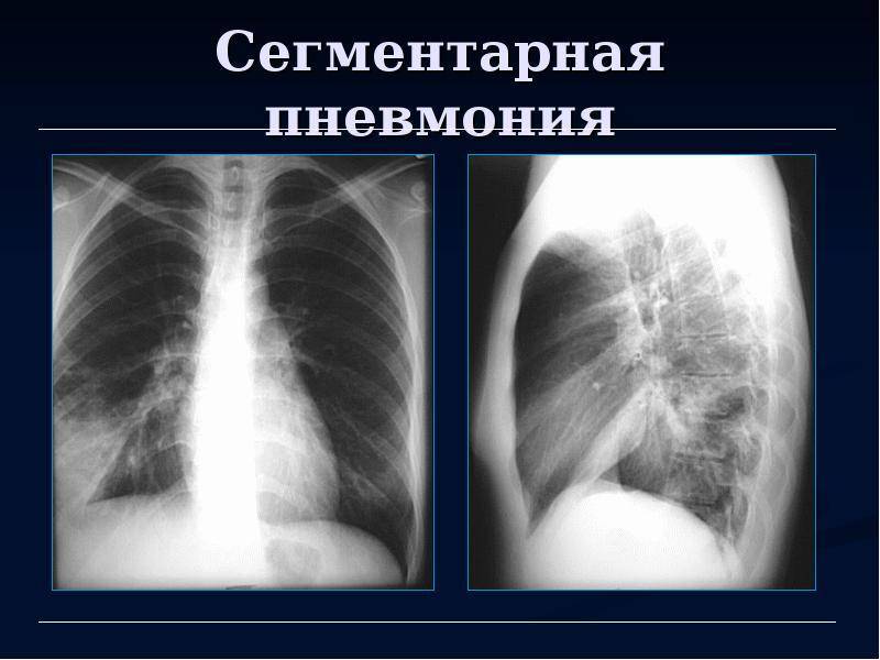 Двусторонняя полисегментарная пневмония у взрослых – причины внебольничной