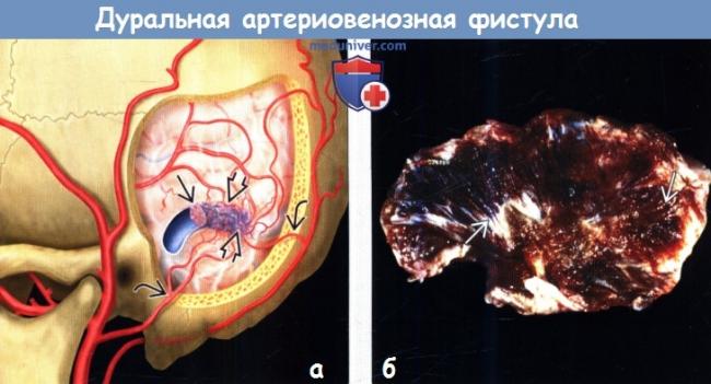Причины появления артериовенозной фистулы и методы ее лечения
