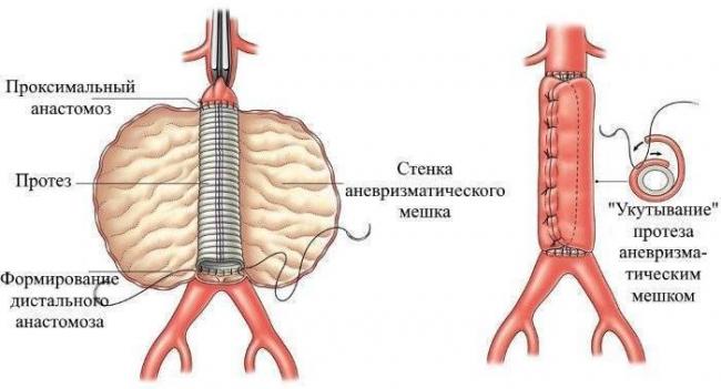 Аневризма аорты брюшной полости: симптомы и причины, диагностика, лечение и прогноз жизни