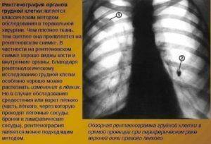 Единичные очаги в лёгком