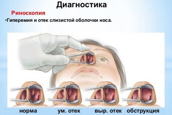 Что делать при атрофии слизистой оболочки носа