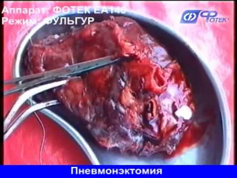 Фиброзно-кавернозный туберкулез легких: сколько с ним живут и как лечат?