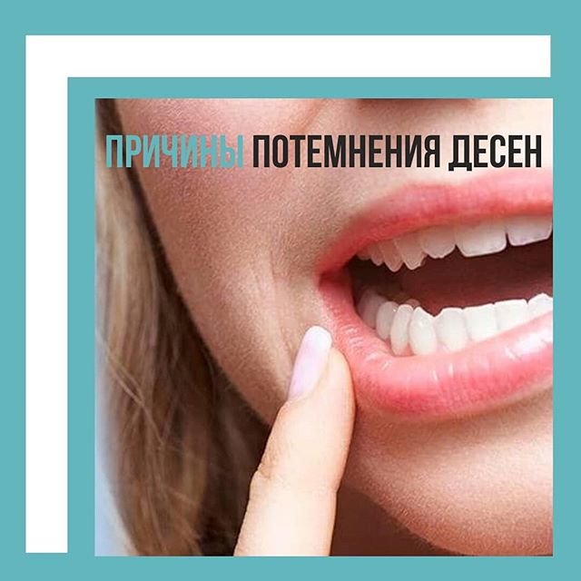 Что делать если кровоточат дёсны