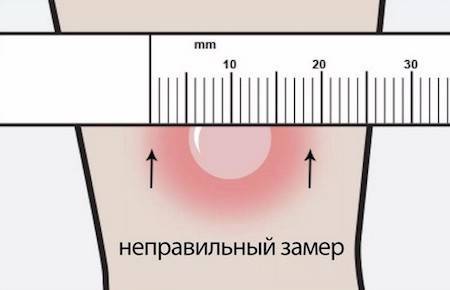 Вред манту: стоит ли отказываться от туберкулиновой пробы?