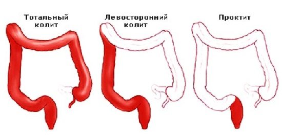 Консервативные и народные методы лечения воспаления слизистой прямой кишки