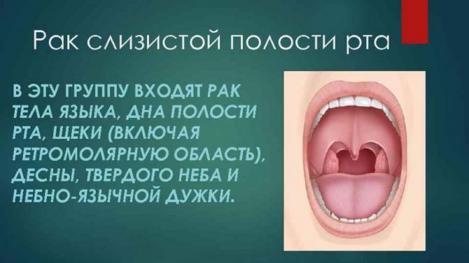 Чем лечить боль в горле при глотании с одной стороны без температуры