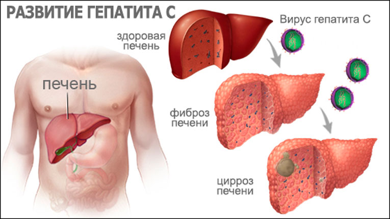 Что полезно при гепатите б