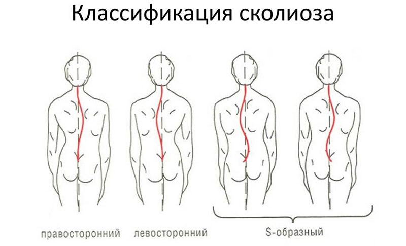 Сколиоз у детей: симптомы и лечение, эффективные упражнения и профилактика