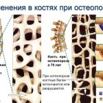 Артра (artra). отзывы больных применяющих этот препарат, инструкция, аналоги, цена