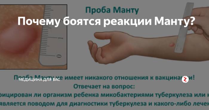 Какие противопоказания бывают у реакции манту