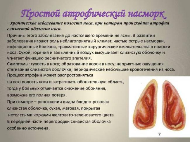 Ринит хронический атрофический: этиология, симптомы и лечение