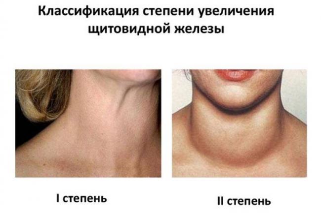 Опасности развития зоба щитовидной железы и его признаки