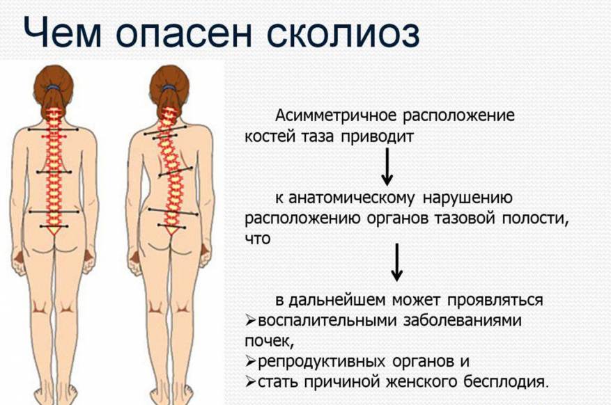 Искривление позвоночника и нарушение осанки у детей (причины и фото)