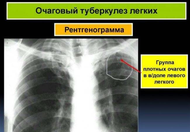 Очаговый туберкулез легких заразен или нет, а также классификация, формы и лечение очагов и уплотнений