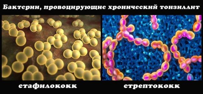 Закаливание горла при хроническом тонзиллите
