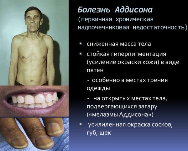 Болезнь аддисона. причины, симптомы, диагностика и лечение патологии