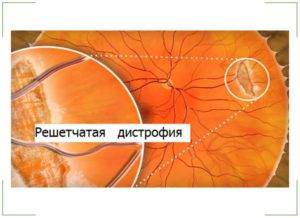 Как «зашить» сетчатку и нужно ли это делать?