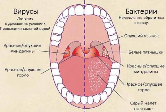 Симптомы отека горла и его лечение