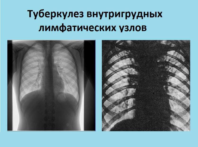 Туберкулезный лимфаденит: причины, симптомы и лечение