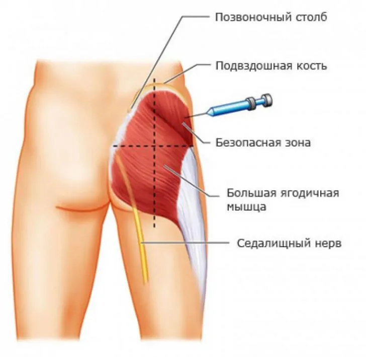 Укол лидокаина с димедролом