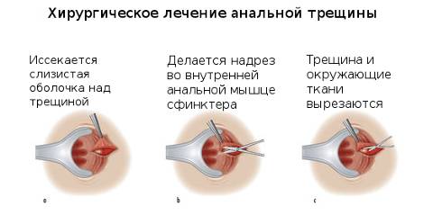 Анальная трещина