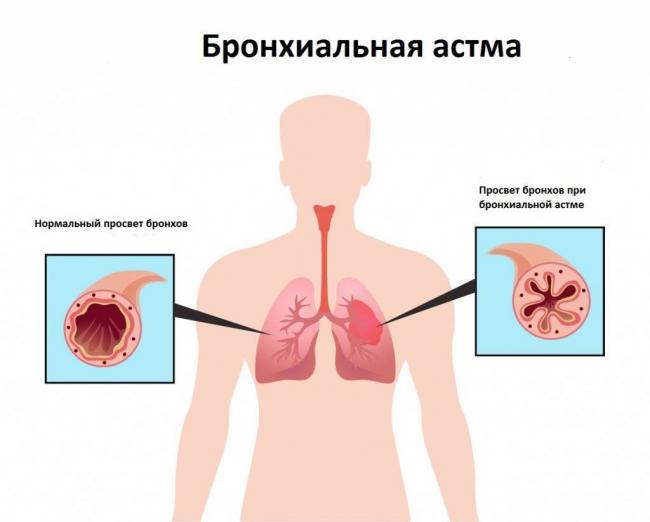 Боль в грудной клетке при кашле после пневмонии