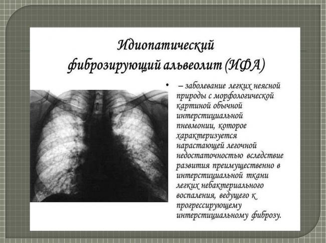Фиброзирующий альвеолит, идиопатический, токсический, экзогенный аллергический альвеолит – симптомы, прогноз жизни