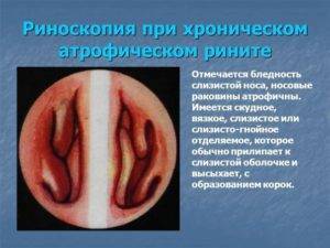 Хронический атрофический ринит: симптомы и лечение