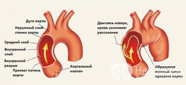 Аневризма брюшной аорты: лечение, симптомы, причины, профилактика | болезни артерий | сосудистый центр им. т.топпера