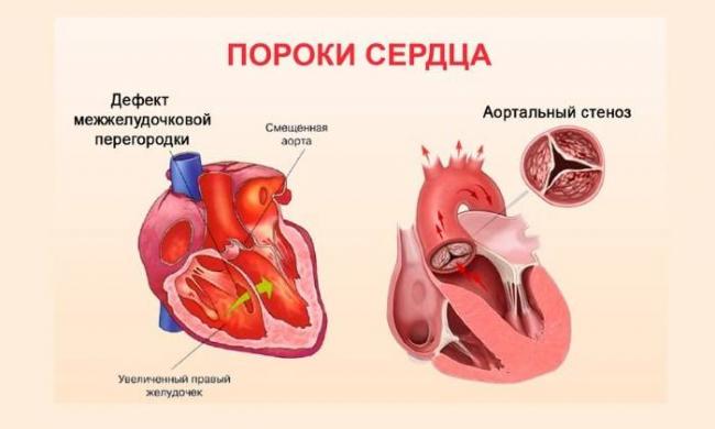 Индометацин Софарма