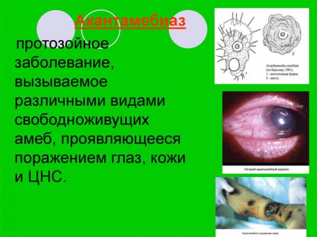 Акантамебиаз: причины, симптомы, диагностика, лечение