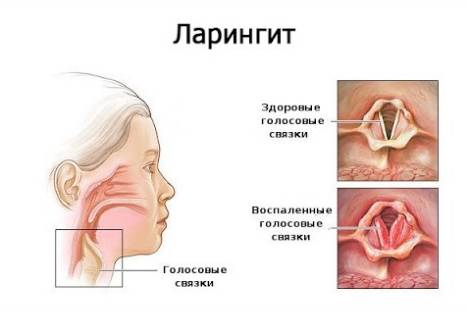Ларингит. причины, симптомы и лечение ларингита.