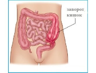 Заворот тонкой кишки симптомы у взрослых. заворот кишок — симптомы у взрослых и детей, причины и лечение