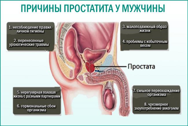 Острый простатит у мужчин: симптомы, лечение, причины возникновения