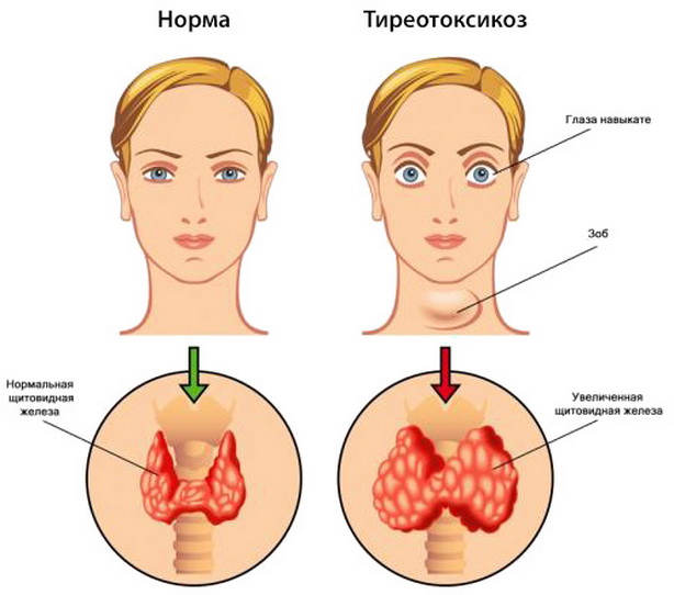 Хронический тиреоидит симптомы лечение