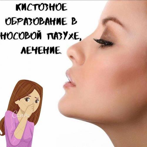 Как избавиться от гайморита: народные и домашние средства