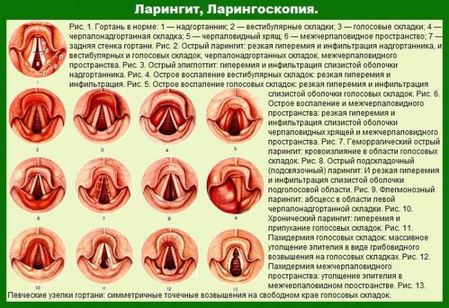 Ларингит - описание болезни