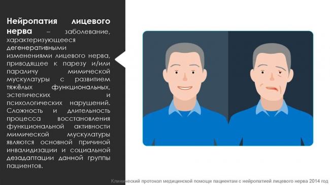 Лечение пареза лицевого нерва