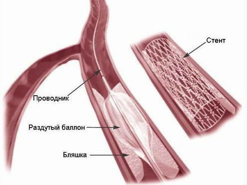 Окклюзия сосудов