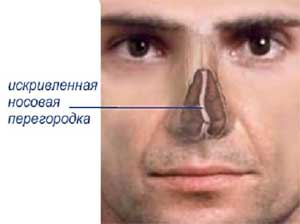 Операция по исправлению носовой перегородки или септопластика